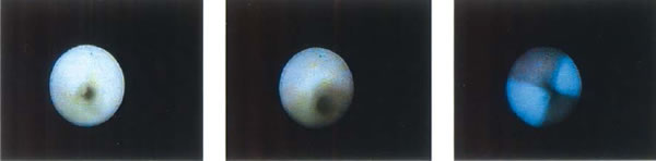 На ряде снимков, выполненных при эндоскопическом исследовании семявыносящего протока, показаны полая игла и характерная спиралевидная структура протока. Также видны белые пятна семенной жидкости.